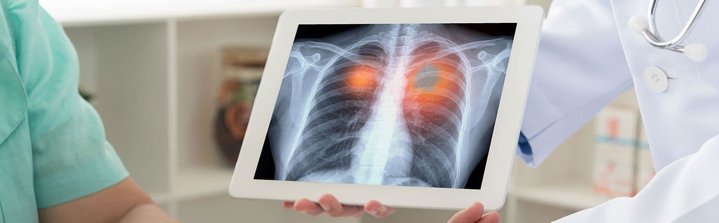 lung-transplant-cost-in-india.html